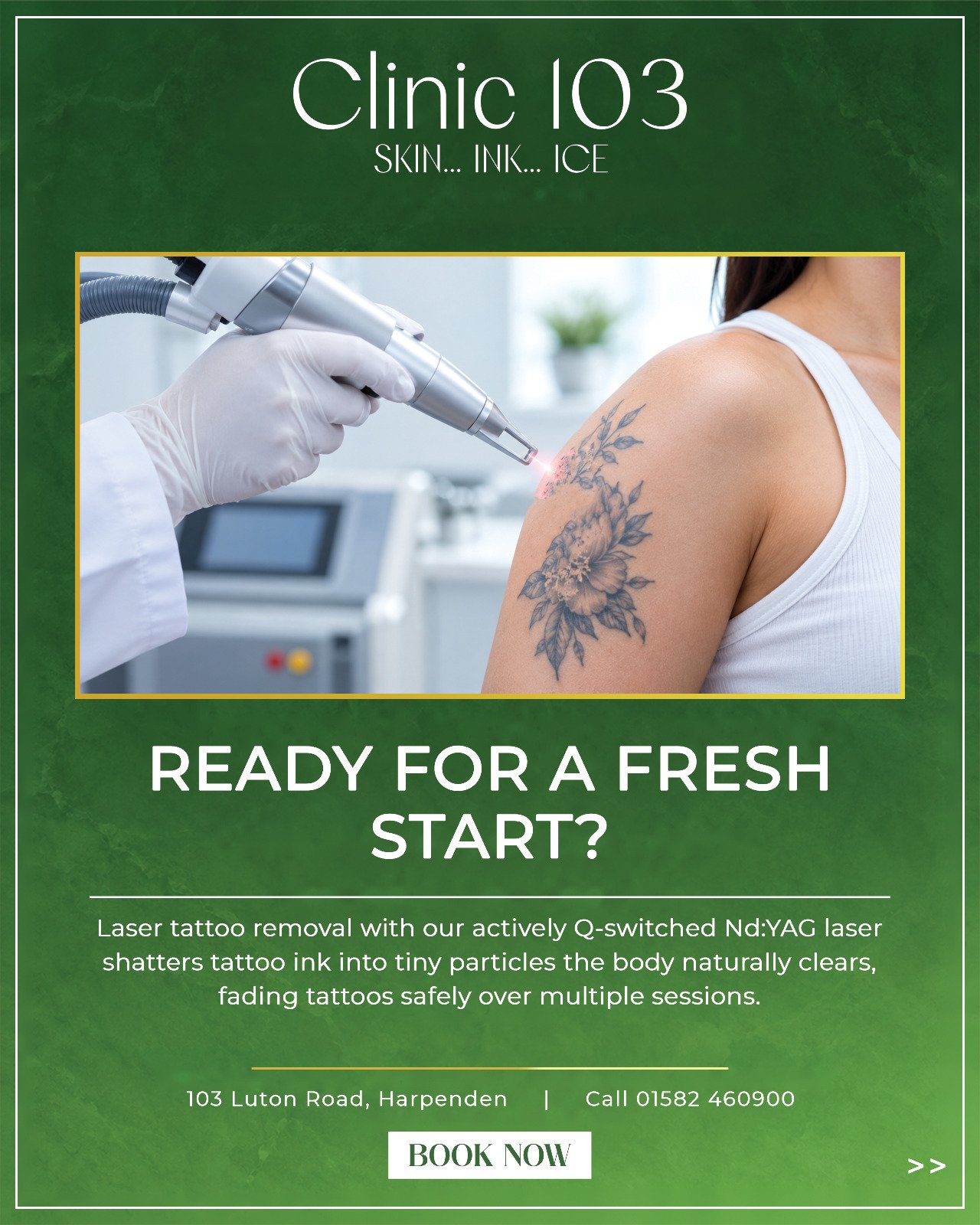 Laser tattoo removal with actively Q-switched Nd:YAG laser at Clinic 103 Harpenden